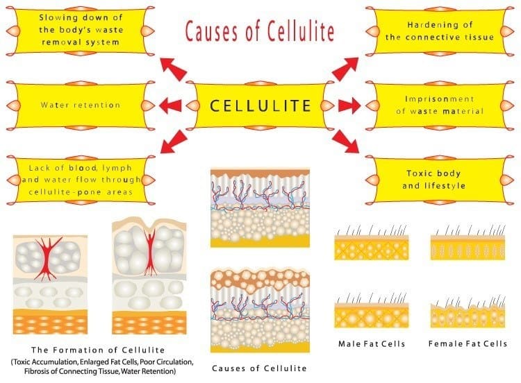 A graph explaining the causes of cellulite.