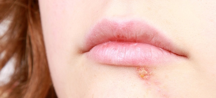 A woman with a cold sore on her lip.