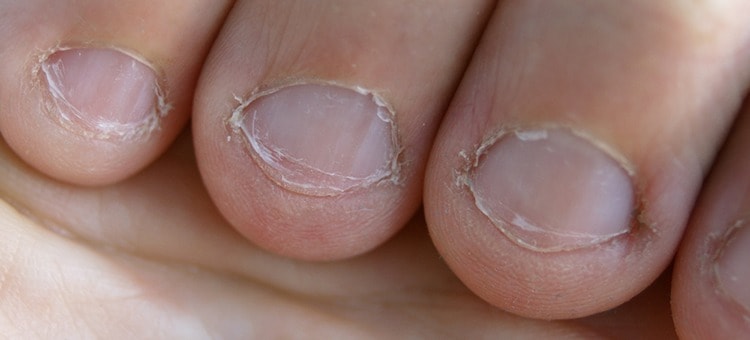 Broken nails on a person's fingers.