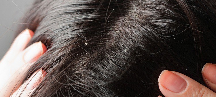 Close-up of dandruff on hair.