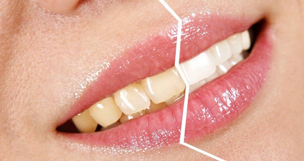 A smiling woman's teeth in a before-after style image, with the left side of her teeth being yellow, while the right side is white. 